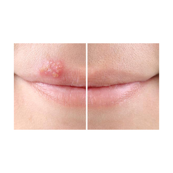 SoreFix Cold Sore Duo Patch