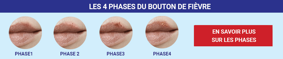 Un Bouton De Fièvre Sappelle également Boutons De Fièvre