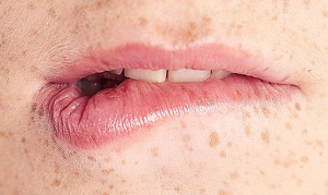 Bescherm je lippen tegen koortslip triggers