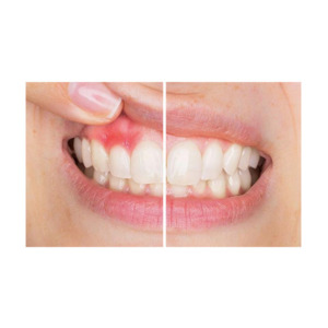 SoreFix Aften Plus Gel